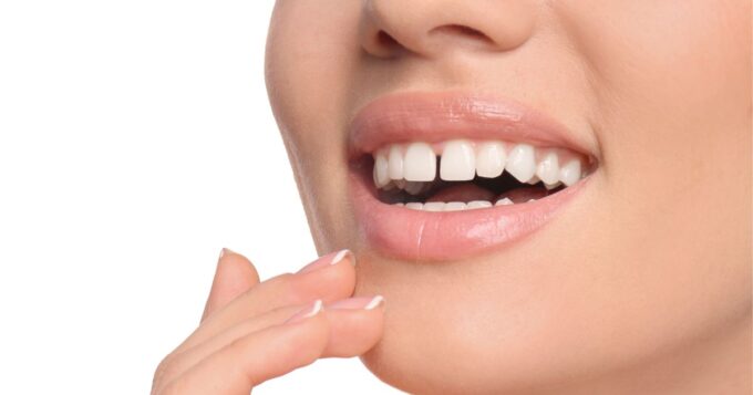 diastema-caratteristica