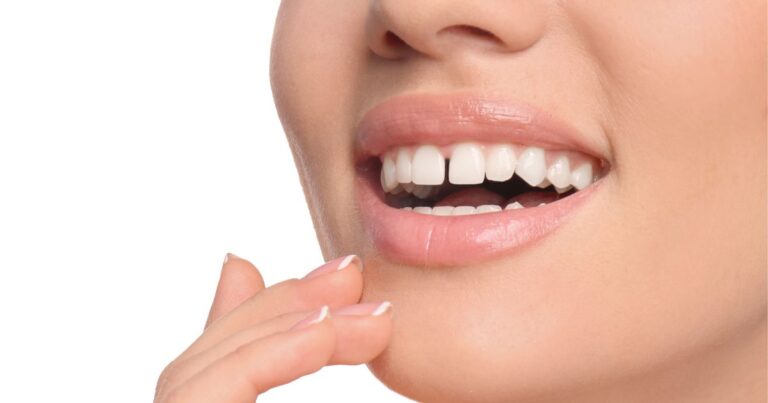 diastema caratteristica