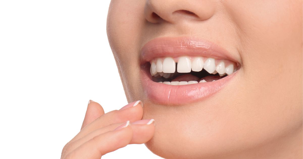 diastema-caratteristica
