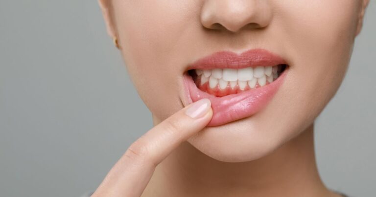 gengive arrossate infiammate